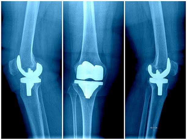 Orthopedic Reconstruction Market: Regional Insights & Investment Opportunities